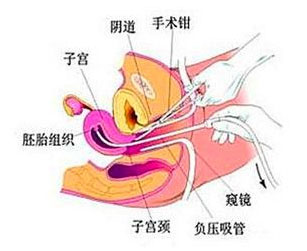 刮宫术过程