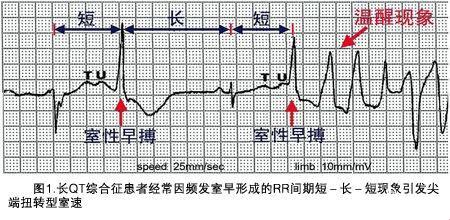 遗传性LQTS心率失常