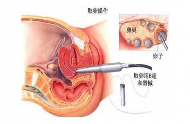 福州“二孩政策”致浙江试管婴儿激增，但费用和成功率不成正比